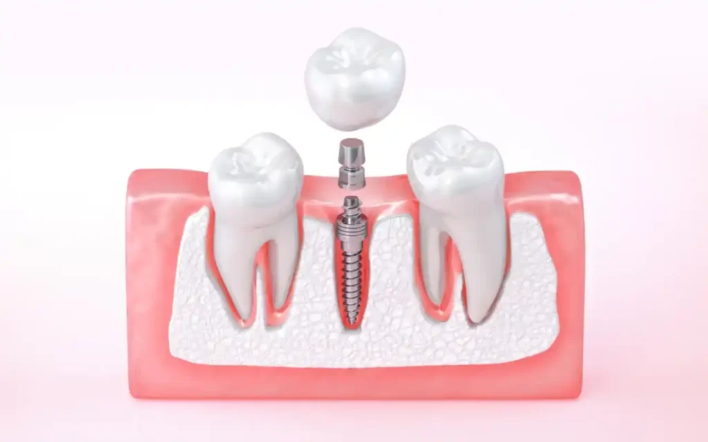 Regeneración dental: adiós a los implantes tradicionales