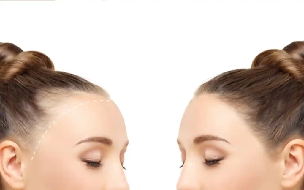 Secretos para el crecimiento del cabello en las entradas