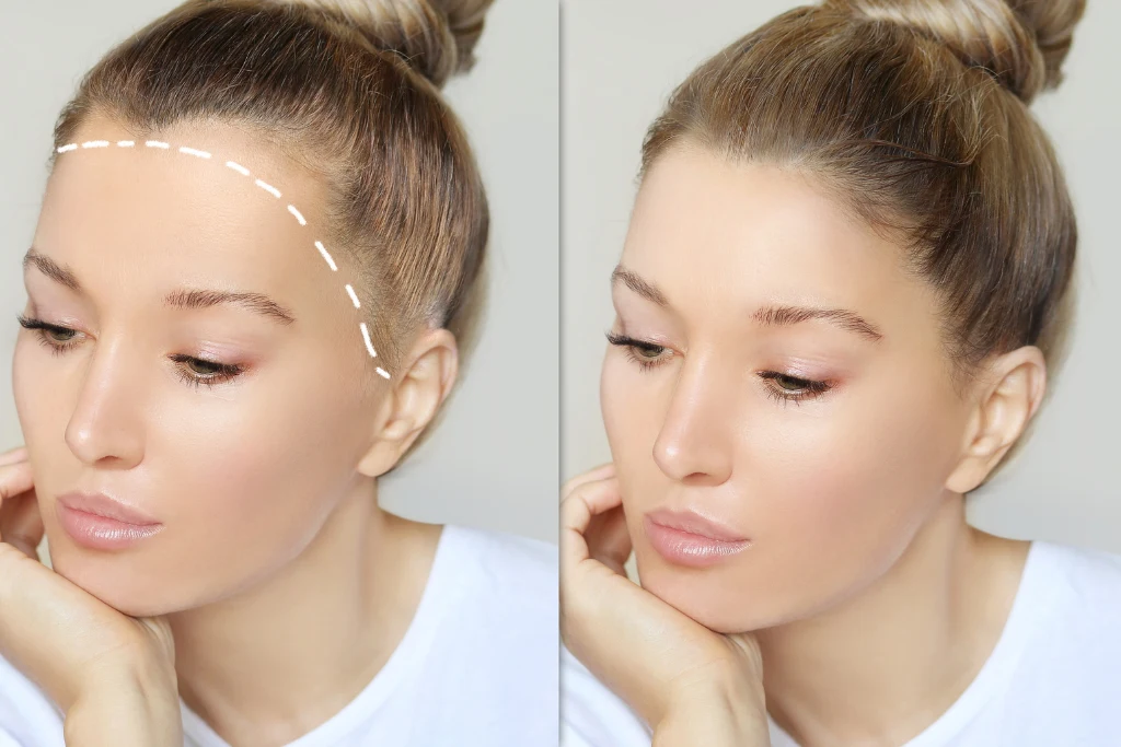 Mujer con alopecia visible en la línea frontal del cabello, imagen que representa la pérdida del cabello y el adelgazamiento capilar | Qué Onda